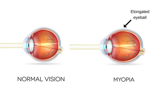 testmozgás emberekkel myopia myopia)