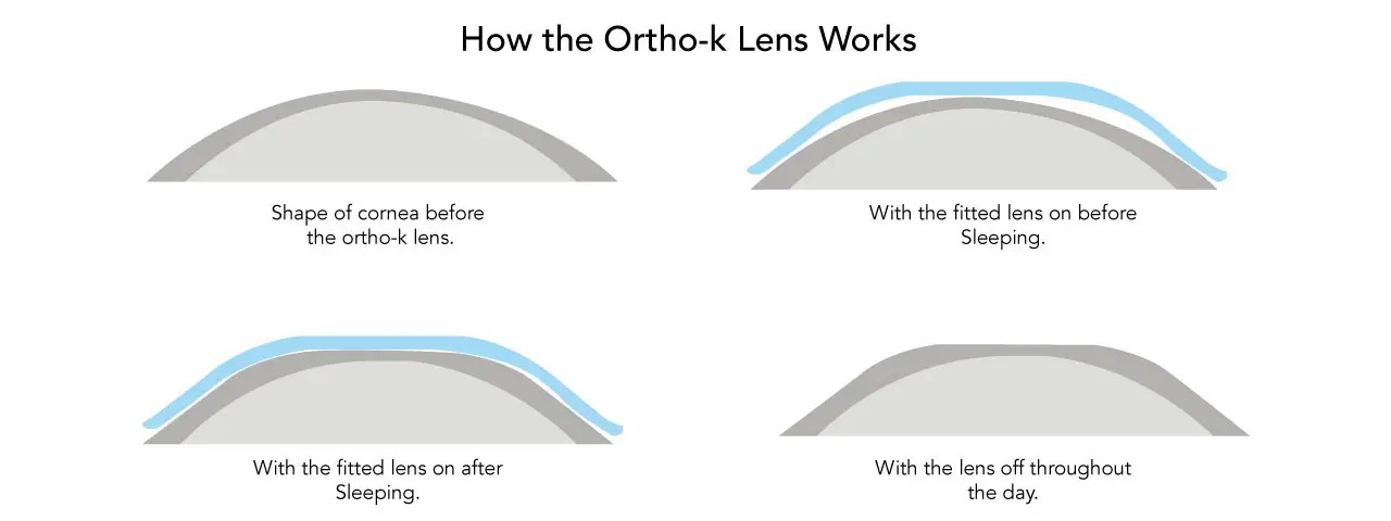 diagrams how Ortho-K lens work