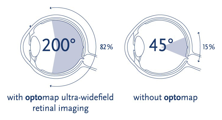 graphical depictions of 2 eyes one with Optomap and one without